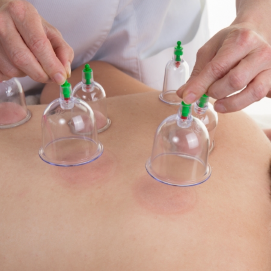 30 Minute Cupping Therapy